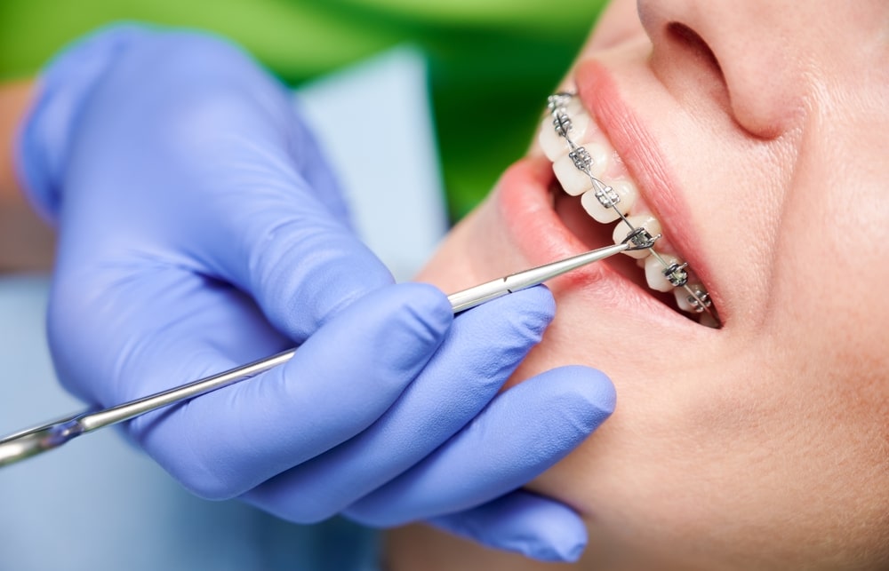 Discover Your Confident Smile With An Orthodontist in Harrisonburg, VA